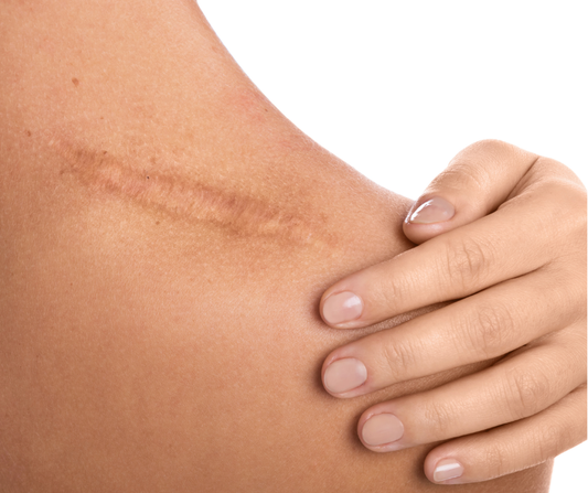 The Best Post-Biopsy Scar Care Treatments